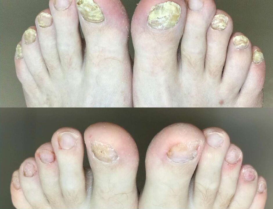 Promismal cream of fungi before and after treatment
