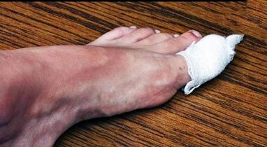Compressors for the treatment of fungi in the thumb of the foot