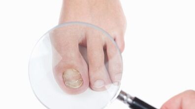How to treat a fungus on the thumb of the foot