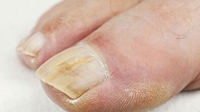 Reasons for the image of the mushroom on the thumb of the foot