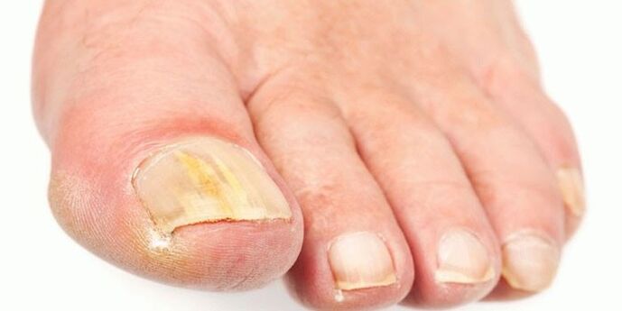 Effective products from nail fungi