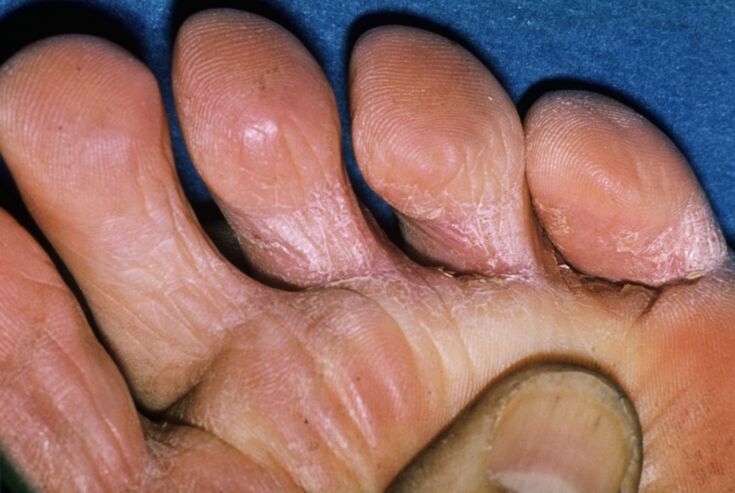 Fungus on toes