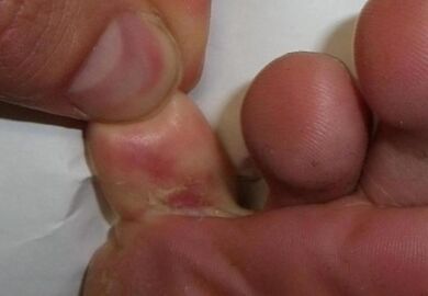 cracked finger due to fungal infection