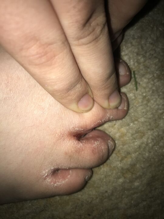 foot fungus infection
