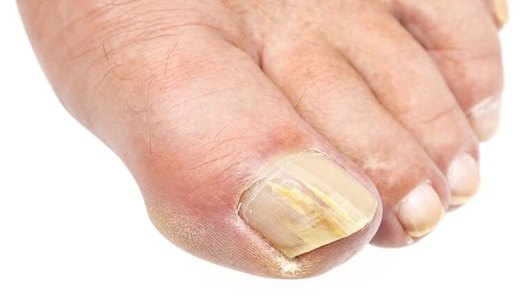 An external change in the nail is a sign of a fungal infection