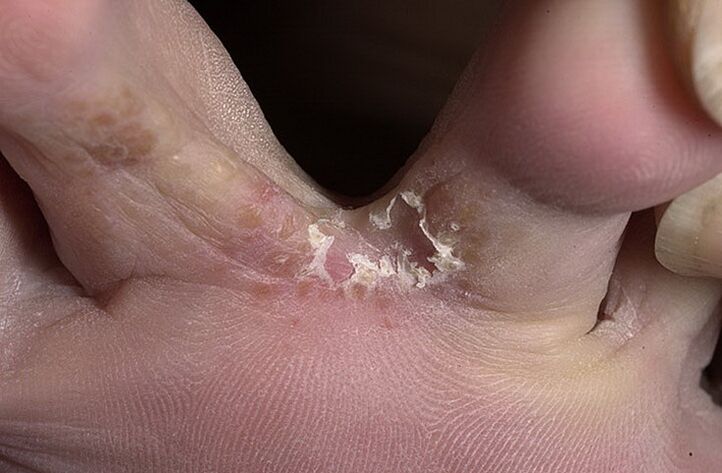 Cracked skin between the toes is a sign of intertriginous fungus