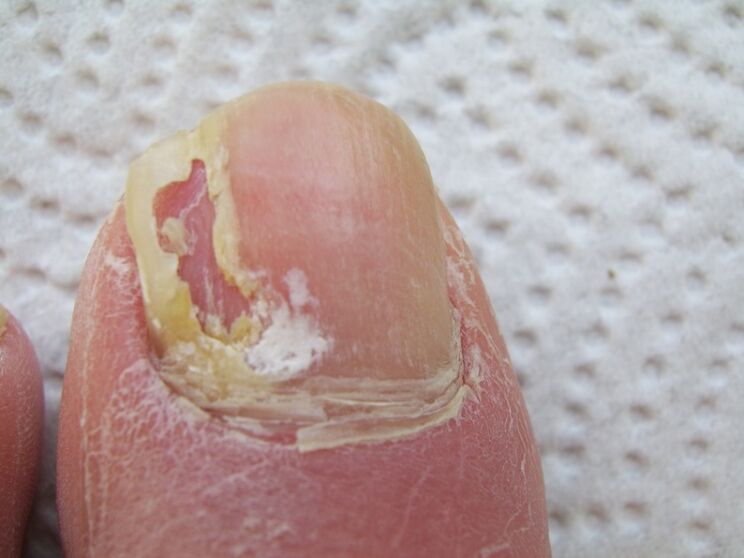 Deformation of the nail plate occurs with onychomycosis
