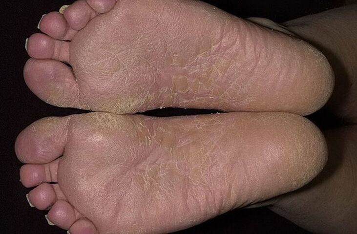 Dry, crusty skin on the feet is a sign of scaly mycosis