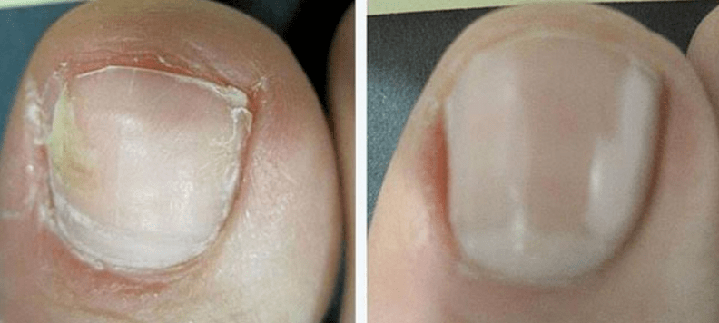 Nail before and after fungal treatment