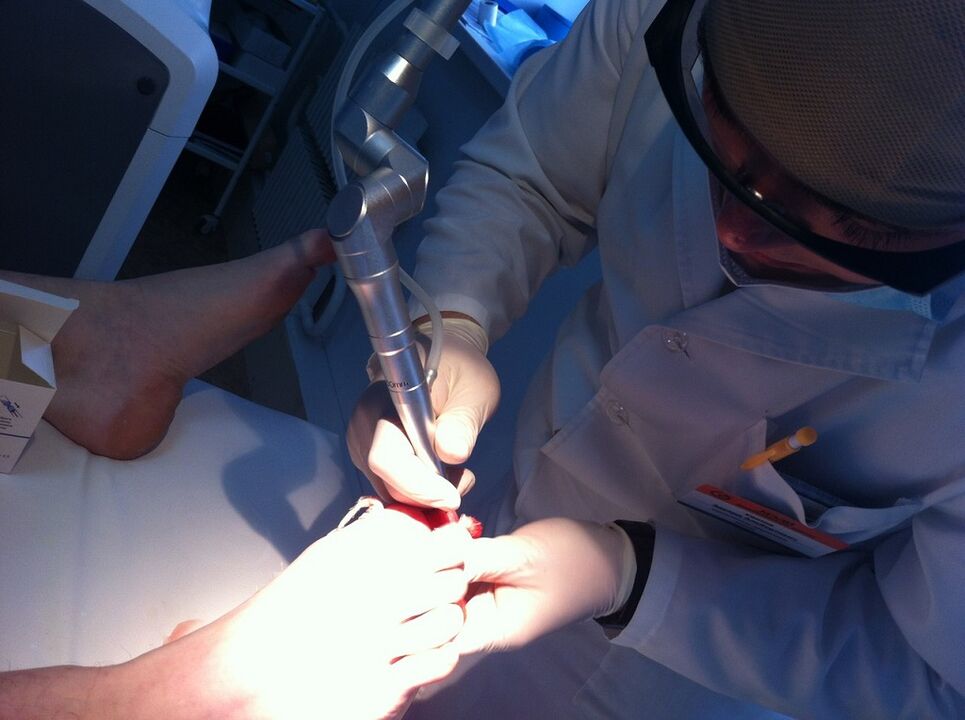 Mikosun Laser Treatment